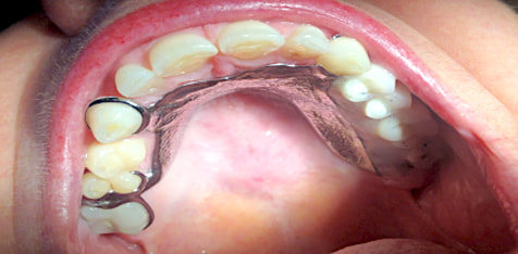 Partial Dentures Tacoma WA